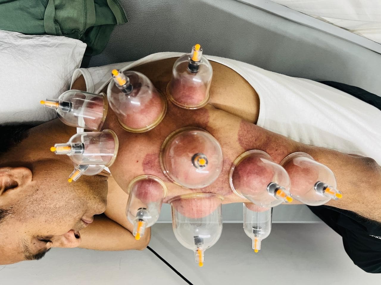 Cupping Therapy